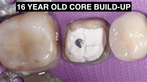 Finally had my new patient exam and I need 4 crowns and 2 root canals. . How long does a core build up last without a crown